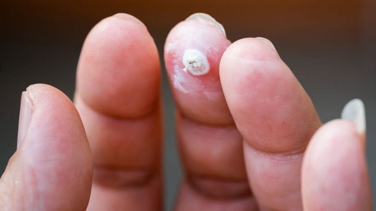 Does Frog Pee Cause Warts? [Science Explains]